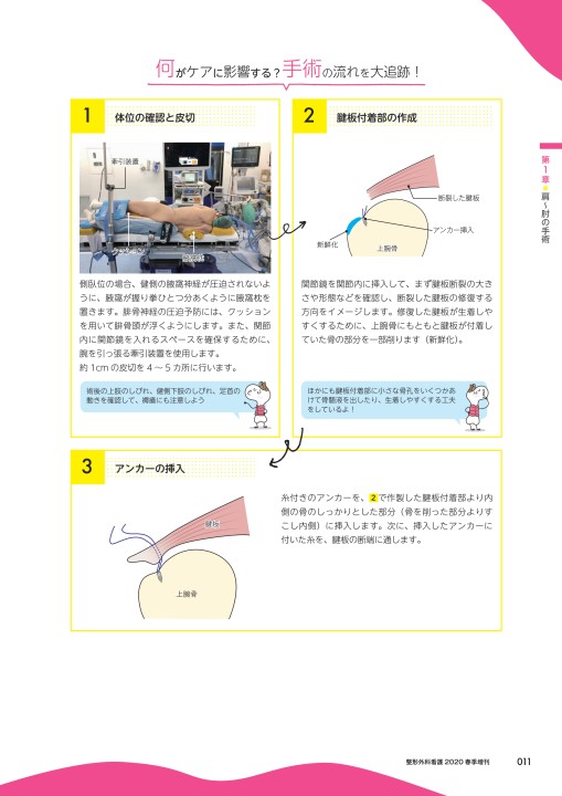 側臥位 手術 体位 腋窩枕 トップ