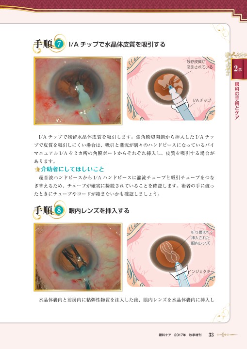 眼科ケア 2017 7冊セット 眼科ケア 2023年4月号 - メルカリ